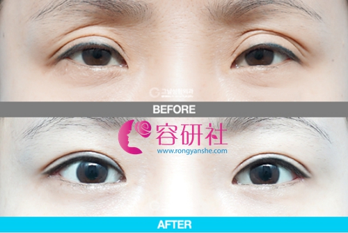 韩国歌娜整形外科眼窝凹陷及多眼皮修复日记.jpg