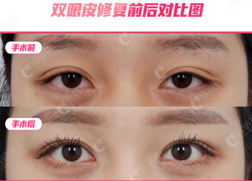 韩国爱她（ATOP）整形外科外科医院双眼皮修复案例