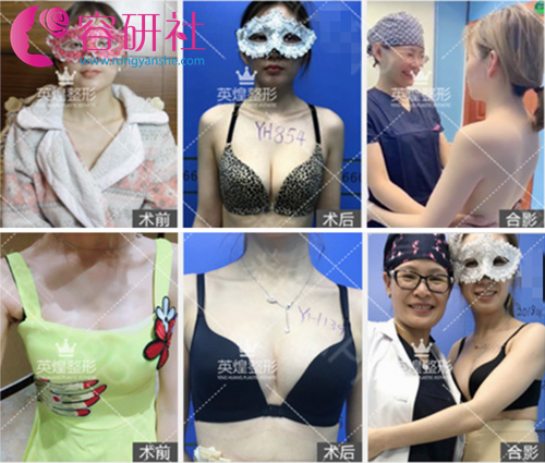 北京英煌梁耀婵自体脂肪隆胸手术案例