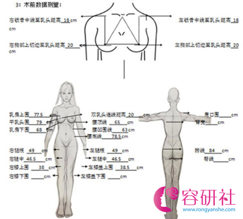 北京英煌梁耀婵自体脂肪隆胸手术特色