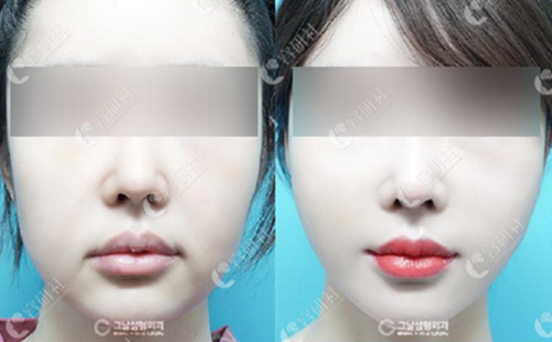 韩国歌娜整形医院迷你拉皮手术案例