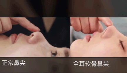 北京联合丽格的师俊莉院长术后可做猪鼻子