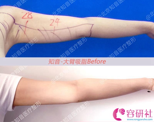 北京知音医疗美容手臂吸脂案例
