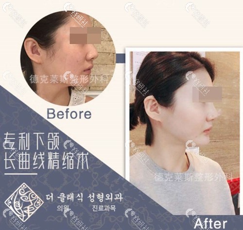 韩国德克莱斯整形外科面部轮廓案例