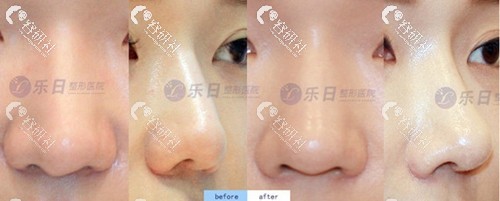 韩国乐日整形外科鼻修复案例