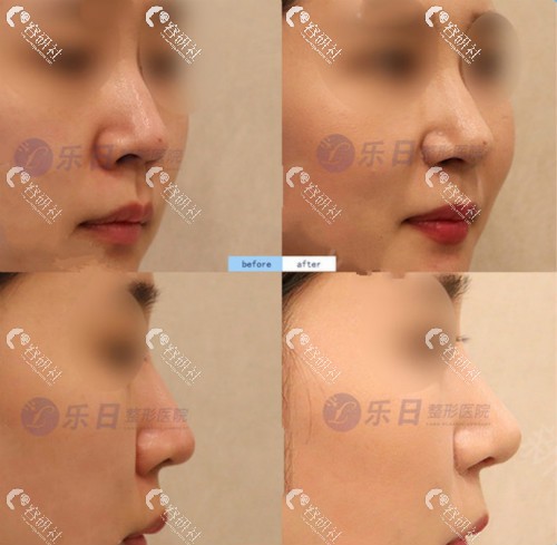 韩国乐日整形外科鼻修复前后对比照