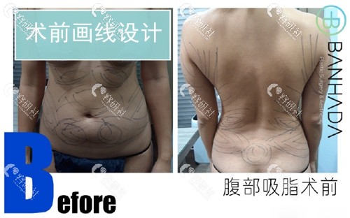 韩国微塑整形医院腰腹吸脂术前画线设计