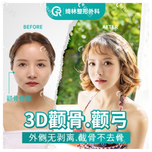 韩国绮林整形医院3D颧骨整形案例
