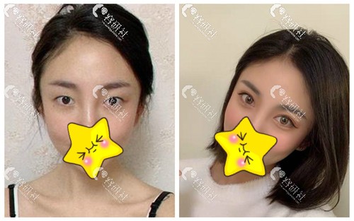 北京华韩医疗美容医院双眼皮整形案例