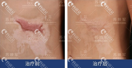 北京联合丽格医疗美容医院手术祛疤日记