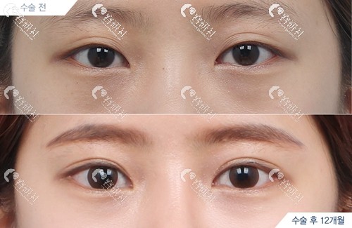 韩国DA整形外科双眼皮修复案例