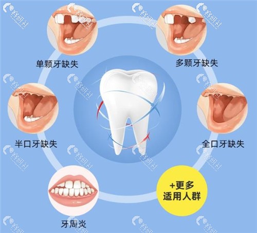 上海中博口腔医院种植牙适应人群