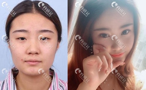 昆山米扬丽格医疗美容门诊部全切双眼皮手术案例