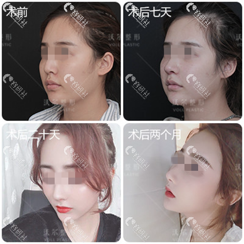 北京沃尔医疗美容诊所隆鼻案例