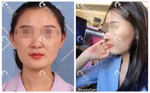 北京美莱医疗美容医院隆鼻案例