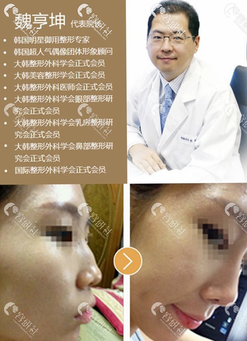 韩国will整形外科医院魏亨坤院长以及鼻整形手术日记