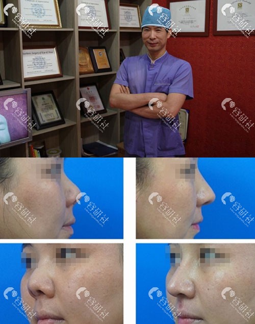 韩国高诺鼻整形外科丁泰荣院长以及鼻整形手术日记