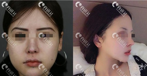 上海首尔丽格医疗美容医院石润下颌角整形案例