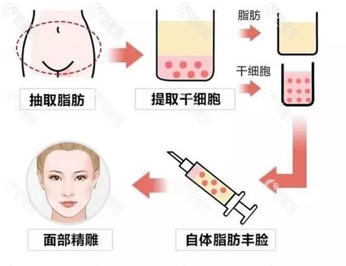 自体脂肪填充手术过程示意图