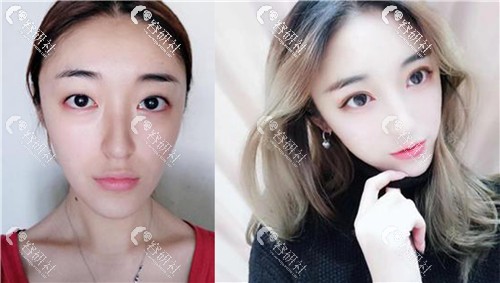 上海薇琳医疗美容医院双眼皮案例
