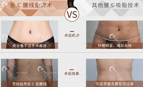 反C腰线重塑术和其他腰部吸脂技术的区别