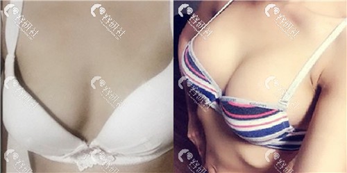 上海铂曼医疗美容门诊部余力双平面隆胸案例