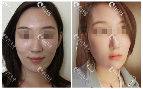 北京宫国华医疗美容诊所手术缩鼻头案例