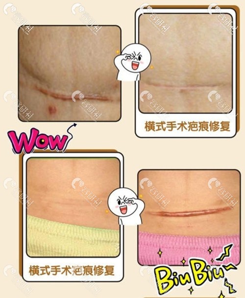 上海茸城医疗美容医院李亚军剖腹产疤痕修复日记