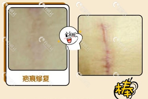 上海茸城李亚军剖腹产疤痕修复前后对比照