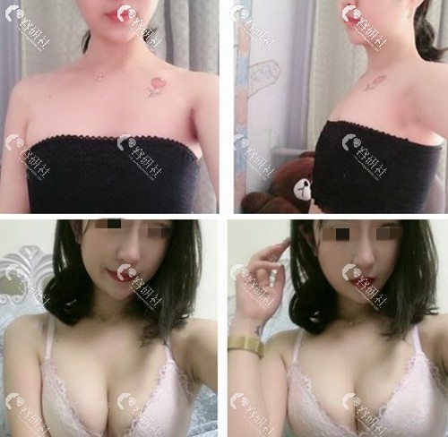 上海时光整形外科医院假体隆胸案例