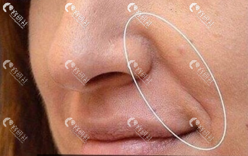面部提升改善鼻唇沟效果明显吗?国内有哪些医院可以做?