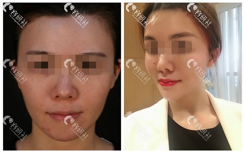 上海薇琳医疗美容医院面部提升案例