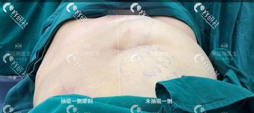 北京美莱医疗美容医院宋延刚腰腹吸脂两边效果对比
