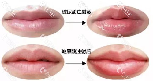 玻尿酸注射丰唇前后对比图