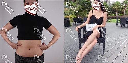 上海华美医疗美容医院吸脂瘦腰腹前后对比图