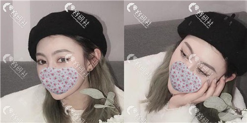杭州艺星医疗美容医院打瘦脸针术后25天