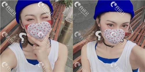 杭州艺星医疗美容医院打瘦脸针术后100天