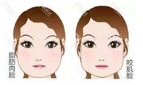 脂肪型脸宽和咬肌型脸宽的区别