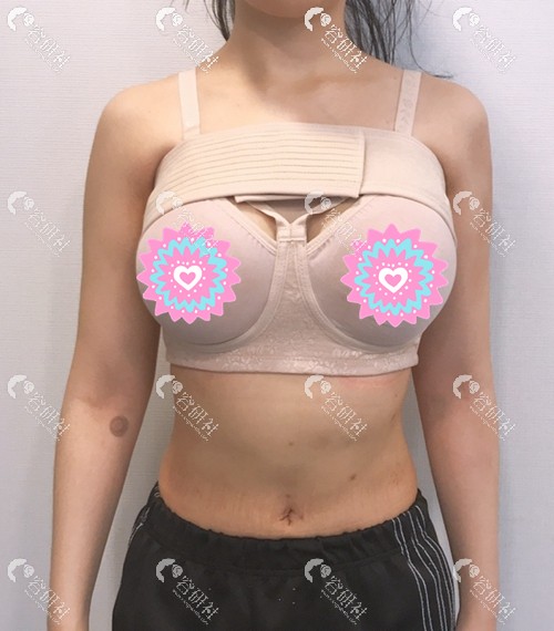 在韩国普罗菲耳做魔滴假体隆胸术后第二天穿着塑身衣