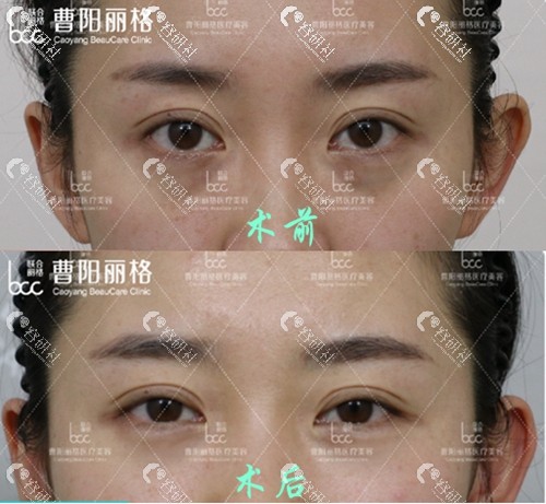 重庆曹阳丽格医疗美容诊所眼袋整形案例