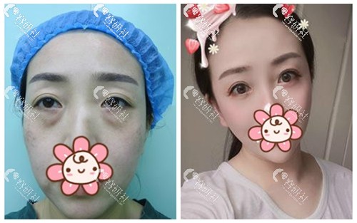 北京百达丽医疗美容门诊部余东眼袋手术案例