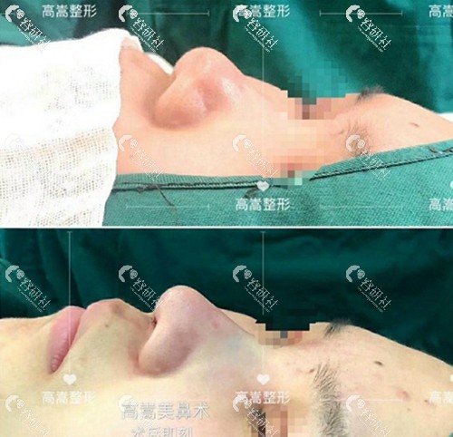蚌埠医学院第（一）附属医院整形美容外科高嵩隆鼻术前术后即刻对比