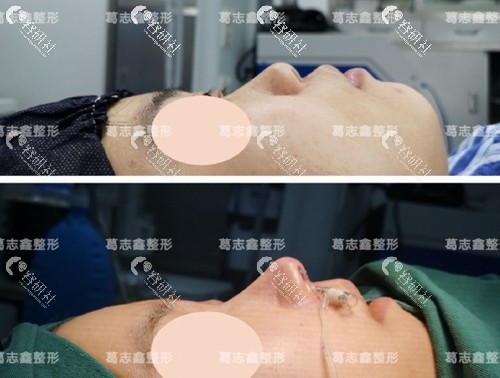 上海知颜医疗美容门诊部葛志鑫隆鼻术前术后对比