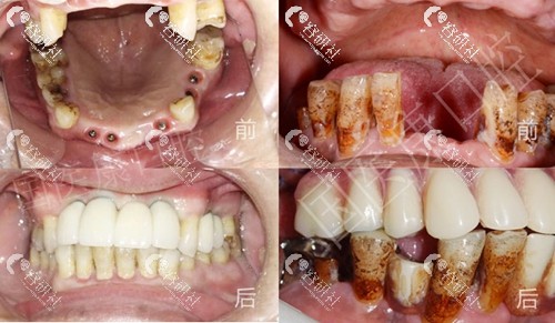 北京国医康口腔牙齿种植日记