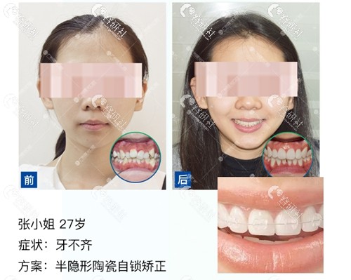 广州牙齿不齐矫正照片