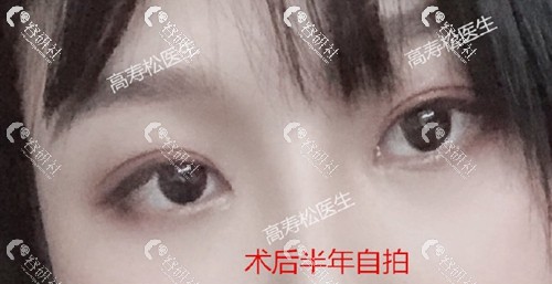 杭州星颜医疗美容诊所高寿松双眼皮失败修复术后半年
