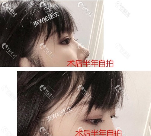 杭州星颜医疗美容诊所高寿松双眼皮失败修复术后侧颜照