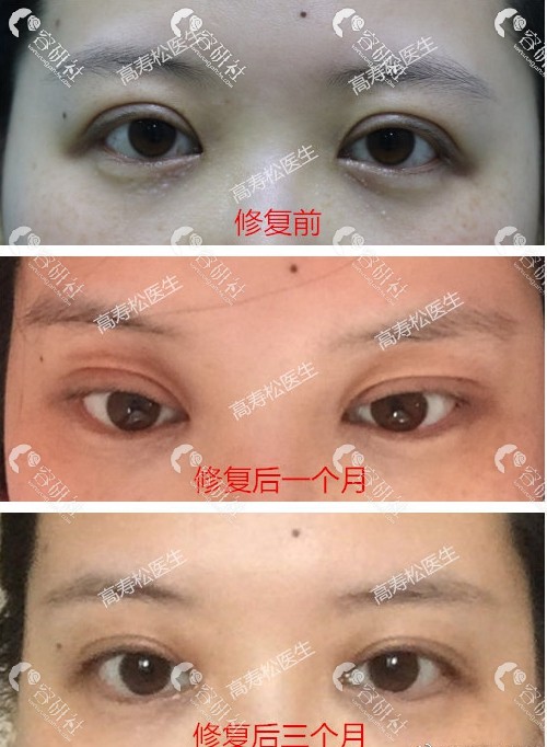 杭州星颜医疗美容诊所高寿松双眼皮失败修复日记