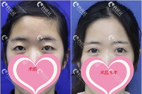 杭州星颜医疗美容诊所高寿松双眼皮失败修复术前术后对比