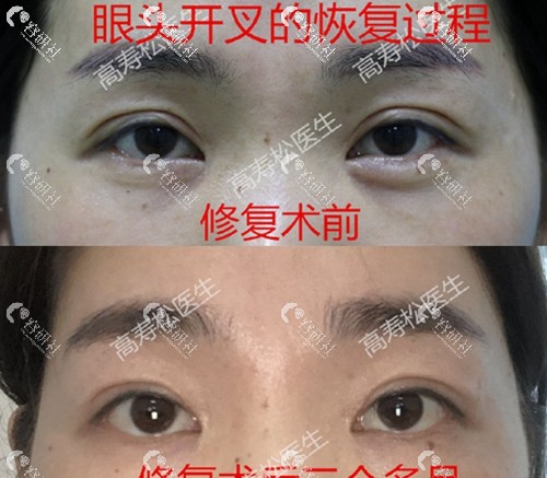 杭州星颜医疗美容诊所高寿松双眼皮失败修复恢复前后对比照